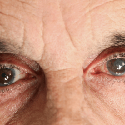 mezczyzna z jaskra na oczach-choroba oczu (1)